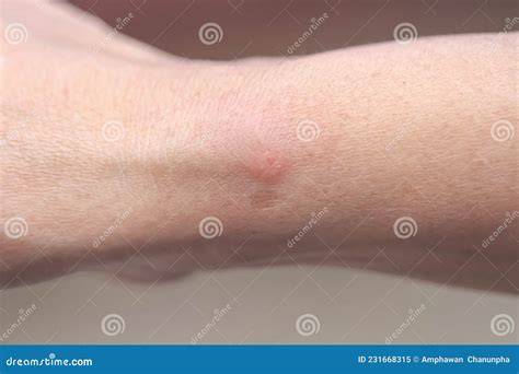 red swelling  insect sting  asian woman skin background royalty