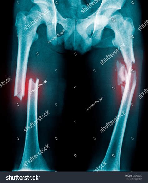 X-Ray Fracture Both Femur Stock Photo 522406399 : Shutterstock