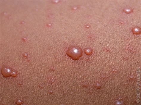 chickenpox  bug bites     difference goodrx