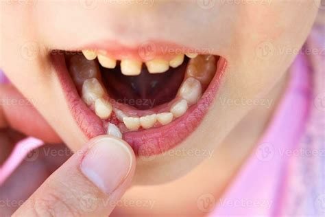 Loose Tooth Stock Photos, Images and Backgrounds for Free Download