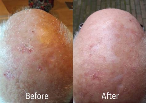 Scalp therapy Peeling Serum | Scalp psoriasis, eczema dermatitis ...