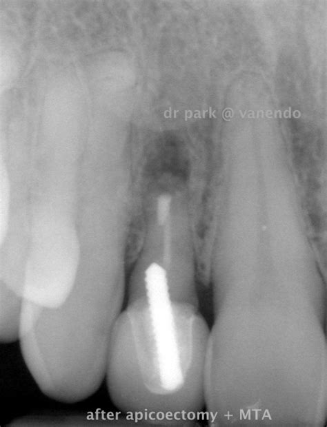 How can an Apicoectomy Help? – EndoLounge