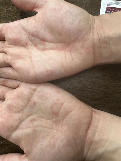Red ring like symptoms underneath the skin. Has anyone seen this? : r