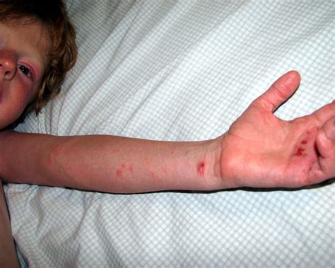 AAD releases first guidelines for pediatric psoriasis treatment