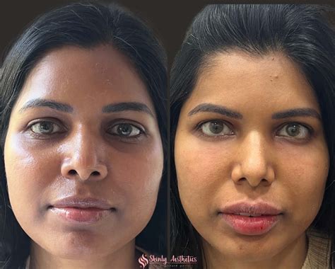 home remedy for baggy under eyes 9