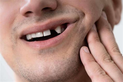 Broken Teeth