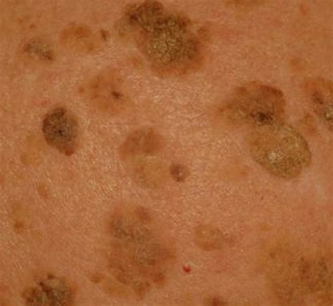 keratosis follicularis scalp recurrent corneal ulcerations