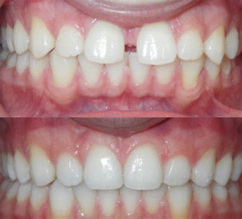 orthodontics oberoi dental clinic