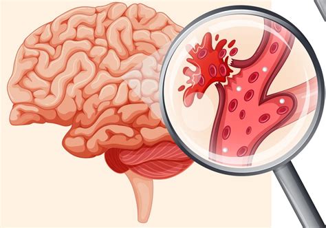 Геморрагический инсульт: типы, клиническая картина и лечение | REW-MED