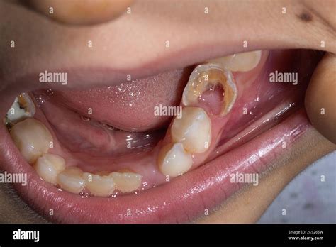 milk teeth caries carious child teeth stock photo alamy