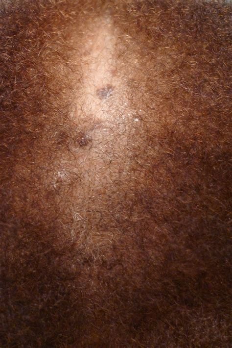 Central Centrifugal Cicatricial Alopecia