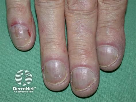 acrocyanosis  features  treatment dermnet