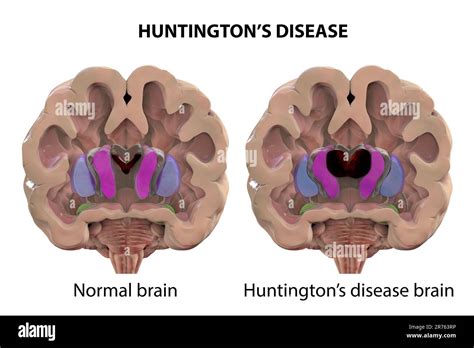 Dorsal striatum and lateral ventricles in healthy brain and in ...