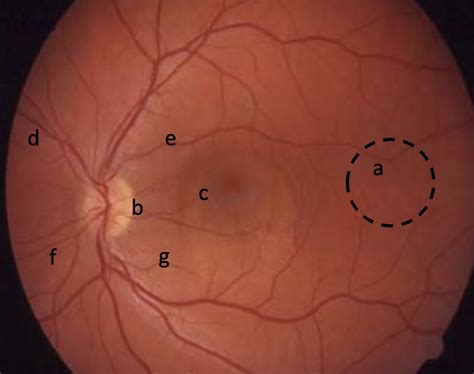 Fundoscopy - Oxford Medical Education