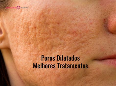 O Que É Poros Dilatados - POROS DILATADOS【TOP 2021 Melhores Tratamentos