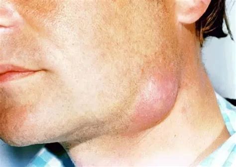 symptoms  treatment  neck phlegmon healthy food