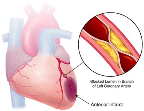 acute myocardial infarction heart beat care center