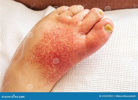 Erysipelas of the Legs, Red Rash on the Legs.selective Focus Stock ...