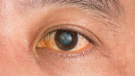 What Is a Cortical Cataract? Symptoms, Causes, and Treatment