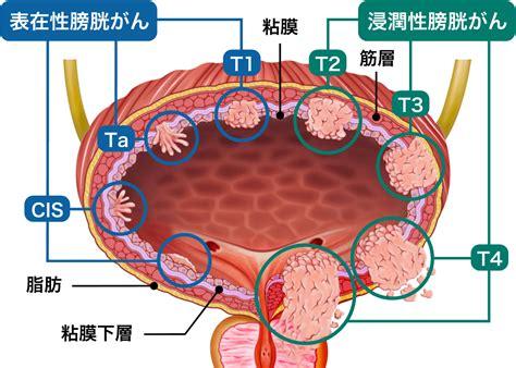 膀胱がんの治療について | 医療法人社団實理会 東京国際大堀病院