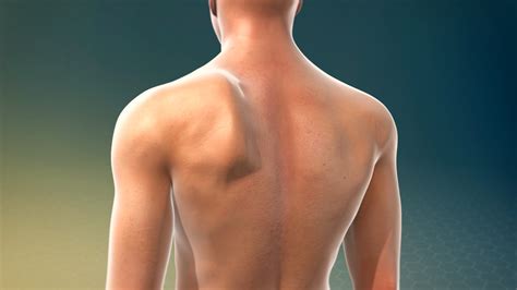 How to Fix a Winged Scapula - Tom Morrison