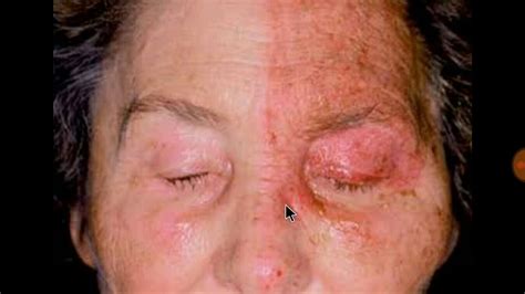 herpes zoster ophthalmicus youtube vrogueco