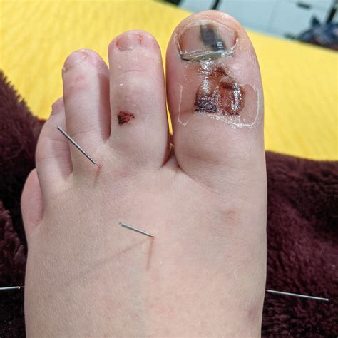 How Do I Know If My Toe Is Broken