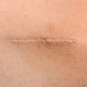 scars burlingame treat  scars