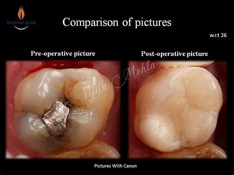 Composite filling | The Dental Arcade – Blog