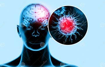 Virus Attacking the Human Brain. Viral Disease Stock Illustration ...