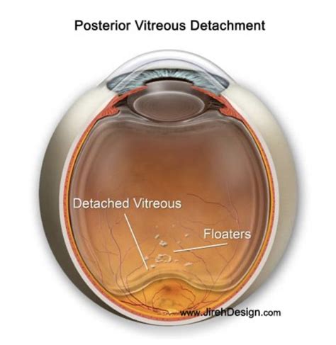 What Are Floaters: Posterior Vitreous vs Retinal Detachment — False ...