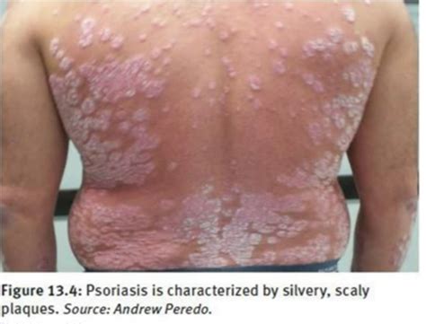 PACES Skin #4 - Psoriasis Flashcards | Quizlet