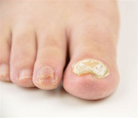 Nail Fungus - Causes, Symptoms and Treatment