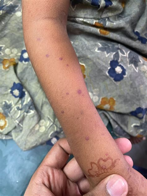 Immuno thrombocytopenic purpura – Clinical features | Pathophysiology