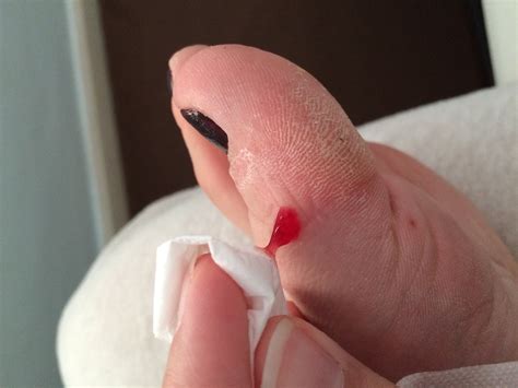 Brand New Cyst Popping Videos Youtube - Surveys Hyatt