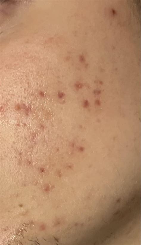 [Acne] Post acne marks : r/SkincareAddicts
