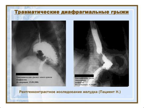 Хирургические заболевания диафрагмы - презентация онлайн