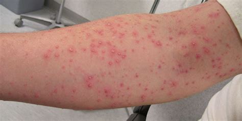 The Symptoms | The MRSA Team