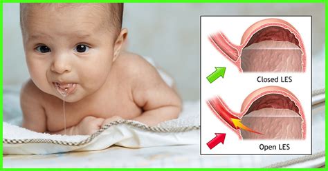 acid reflux  gerd  babies symptoms   treatment