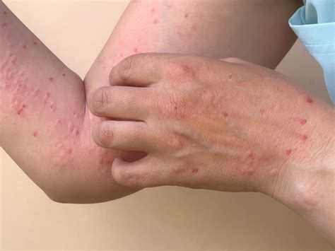 What to Do If You Think You Have Monkeypox Symptoms, According to ... 