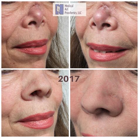 Nose prosthesis for confidence from Wisconsin to Florida