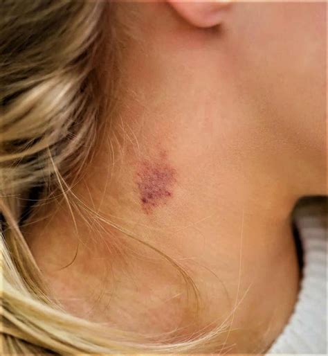 How To Get Rid Of A Hickey Quick and Easy