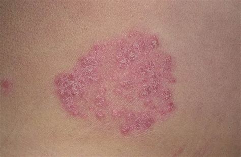 Mild Symptoms Of Plaque Psoriasis at Andrea Mcclelland blog