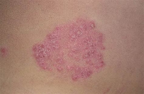 Symptoms Of Plaque Psoriasis