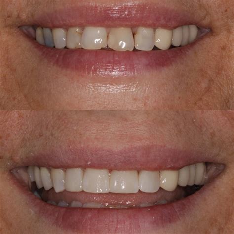 Dentist Before After Gallery, Family and Cosmetic Dentistry in 91367