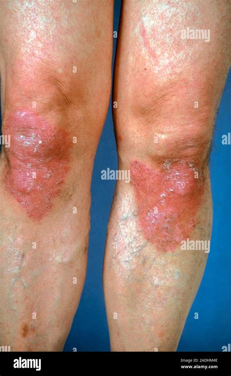 Psoriasis (cause unknown) affecting both knees Stock Photo - Alamy