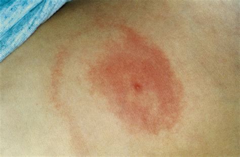 tick bite  red