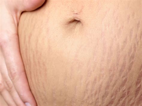 How To Cover Your Stretch Marks With Makeup | Makeupview.co