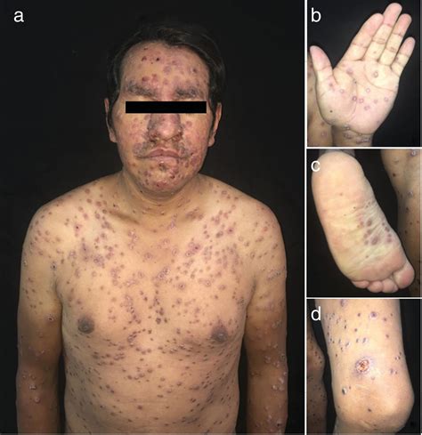 Sífilis maligna y erupción papular pruriginosa en un paciente VIH ...