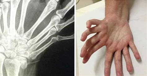 Mirror Hand Syndrome Is Just As Fascinating As It Is Creepy